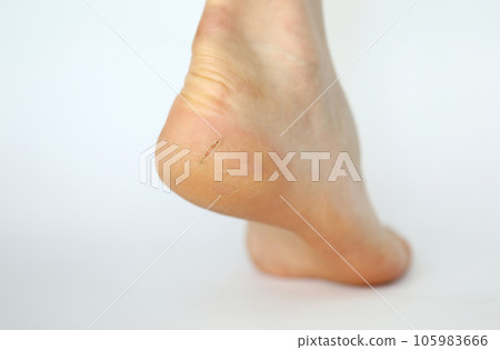 Dry leg covered with painful callous cracks 105983666