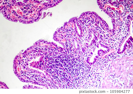 Photomicrograph of chronic cholecystitis Photomicrograph of chronic cholecystitis 105984277