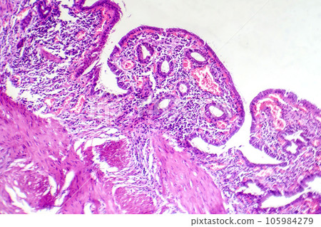Photomicrograph of chronic cholecystitis 105984279