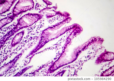 Photomicrograph of intestinal metaplasia 105984290