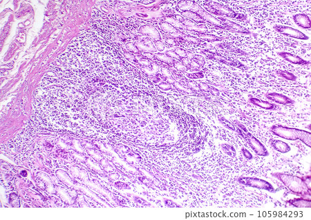 Photomicrograph of intestinal metaplasia Photomicrograph of intestinal metaplasia 105984293