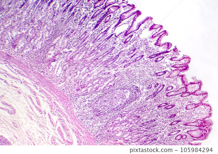 Photomicrograph of intestinal metaplasia 105984294