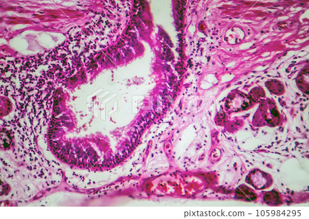 Photomicrograph of bronchial epithelial squamous metaplasia Photomicrograph of bronchial epithelial squamous metaplasia 105984295