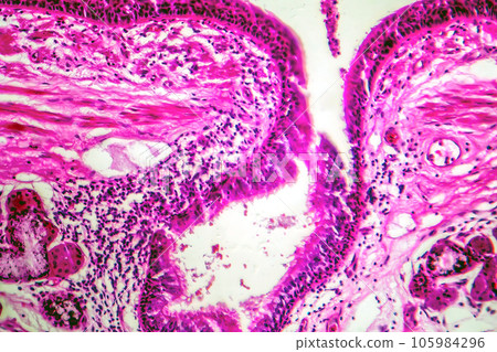 Photomicrograph of bronchial epithelial squamous metaplasia 105984296