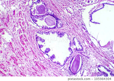 Micrograph of prostatic hyperplasia Micrograph of prostatic hyperplasia 105984304