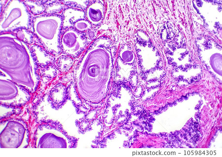 Micrograph of prostatic hyperplasia 105984305