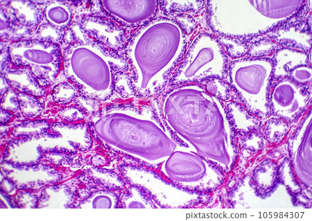 Micrograph of prostatic hyperplasia 105984307