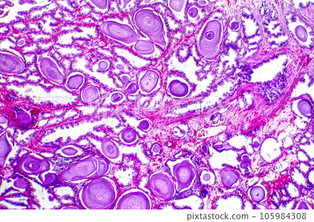 Micrograph of prostatic hyperplasia Micrograph of prostatic hyperplasia 105984308