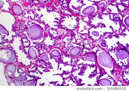 Micrograph of prostatic hyperplasia Micrograph of prostatic hyperplasia 105984310