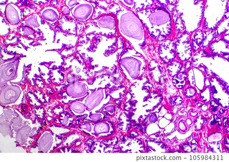 Micrograph of prostatic hyperplasia Micrograph of prostatic hyperplasia 105984311