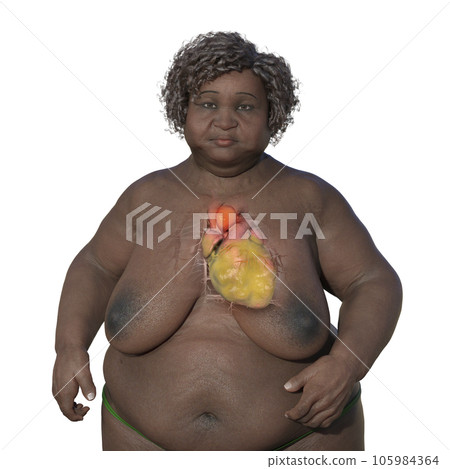 An obese woman with ascending aortic aneurysm, 3D illustration An obese woman with ascending aortic aneurysm, 3D illustration 105984364