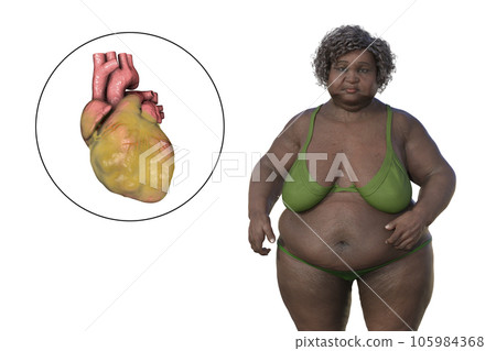 An obese woman with ascending aortic aneurysm, 3D illustration An obese woman with ascending aortic aneurysm, 3D illustration 105984368