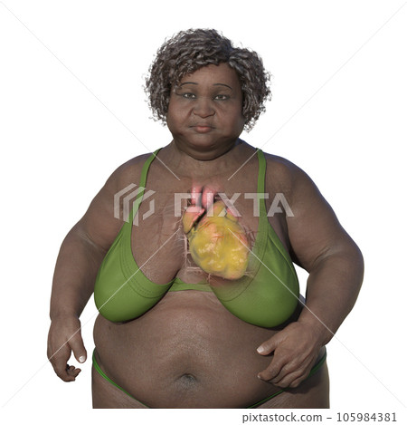 A senior overweight woman with enlarged and obese heart, 3D illustration 105984381