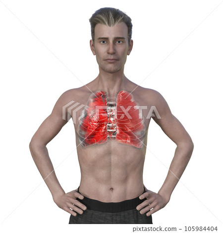 A 3D illustration of a man with the lungs affected by pneumonia 105984404