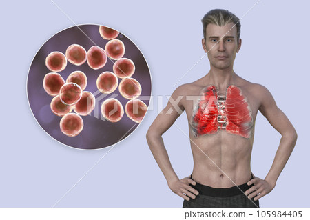 A 3D illustration showcasing the upper half part of a man with transparent skin, revealing the lungs affected by pneumonia 105984405