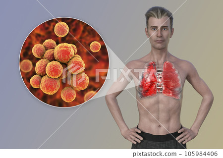 A 3D illustration showcasing the upper half part of a man with transparent skin, revealing the lungs affected by pneumonia 105984406