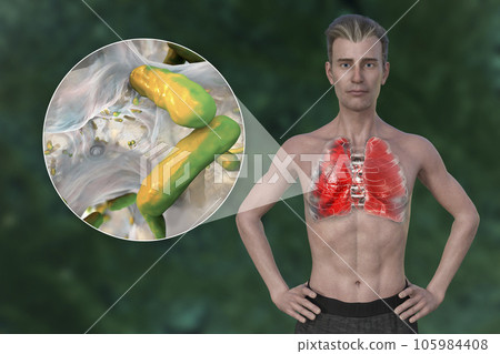 A 3D illustration showcasing the upper half part of a man with transparent skin, revealing the lungs affected by pneumonia A 3D illustration showcasing the upper half part of a man with transparent skin, revealing the lungs affected by pneumonia 105984408
