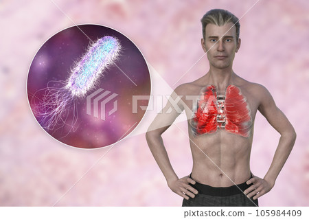 A 3D illustration showcasing the upper half part of a man with transparent skin, revealing the lungs affected by pneumonia A 3D illustration showcasing the upper half part of a man with transparent skin, revealing the lungs affected by pneumonia 105984409