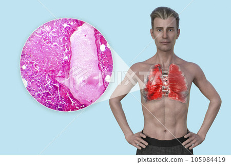 A 3D illustration showcasing the upper half part of a man with transparent skin, revealing the lungs affected by pneumonia 105984419