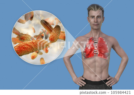 A man with the lungs affected by pneumonia, and close-up view of Klebsiella pneumoniae bacteria A man with the lungs affected by pneumonia, and close-up view of Klebsiella pneumoniae bacteria 105984421