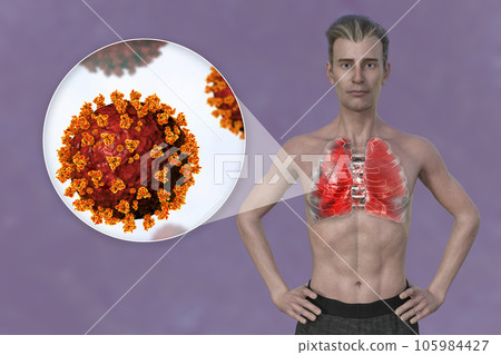 A man with the lungs affected by Covid-19 pneumonia, and close-up view of SARS-CoV-2 viruses A man with the lungs affected by Covid-19 pneumonia, and close-up view of SARS-CoV-2 viruses 105984427