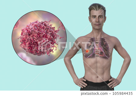 A man with lung cancer, and close-up view of cancer cells, 3D illustration A man with lung cancer, and close-up view of cancer cells, 3D illustration 105984435