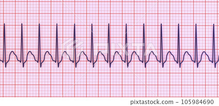 Electrocardiogram displaying supraventricular tachycardia, 3D illustration 105984690