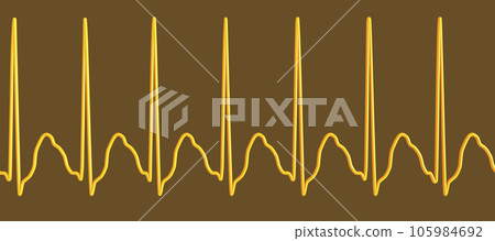 Electrocardiogram displaying supraventricular tachycardia, 3D illustration Electrocardiogram displaying supraventricular tachycardia, 3D illustration 105984692