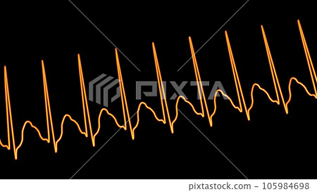 Electrocardiogram displaying supraventricular tachycardia, 3D illustration 105984698