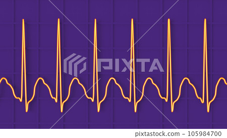 Electrocardiogram displaying supraventricular tachycardia, 3D illustration 105984700