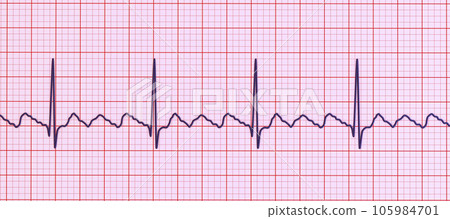 ECG in atrial flutter, 3D illustration ECG in atrial flutter, 3D illustration 105984701