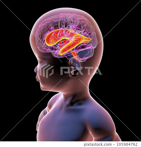 A baby with macrocephaly and enlarged lateral ventricles, 3D illustration A baby with macrocephaly and enlarged lateral ventricles, 3D illustration 105984762