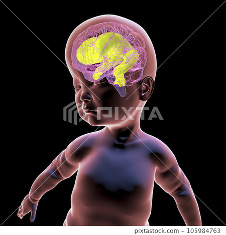 A baby with macrocephaly and enlarged brain ventricles, 3D illustration A baby with macrocephaly and enlarged brain ventricles, 3D illustration 105984763