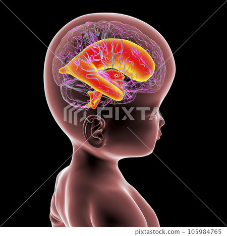 A baby with macrocephaly and enlarged brain ventricles, 3D illustration 105984765