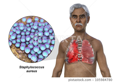 A 3D illustration showcasing the upper half part of a man with transparent skin, revealing the lungs affected by pneumonia 105984780