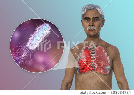 A 3D illustration showcasing the upper half part of a man with transparent skin, revealing the lungs affected by pneumonia A 3D illustration showcasing the upper half part of a man with transparent skin, revealing the lungs affected by pneumonia 105984784