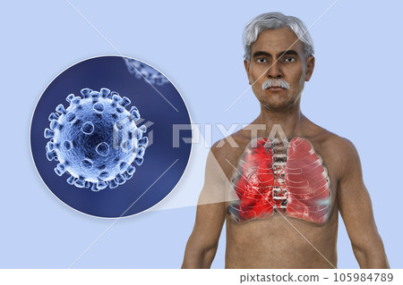 A 3D illustration showcasing the upper half part of a man with transparent skin, revealing the lungs affected by Covid-19 pneumonia A 3D illustration showcasing the upper half part of a man with transparent skin, revealing the lungs affected by Covid-19 pneumonia 105984789
