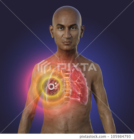A 3D illustration of a man with transparent skin, showcasing the lungs affected by cavernous tuberculosis 105984793