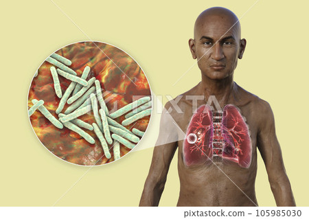 A 3D illustration of the upper half of a man with transparent skin, showcasing the lungs affected by cavernous tuberculosis A 3D illustration of the upper half of a man with transparent skin, showcasing the lungs affected by cavernous tuberculosis 105985030