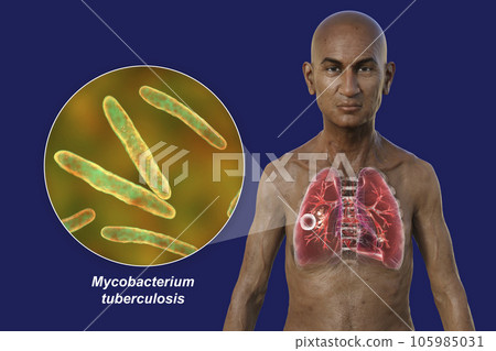 A 3D illustration of the upper half of a man with transparent skin, showcasing the lungs affected by cavernous tuberculosis 105985031