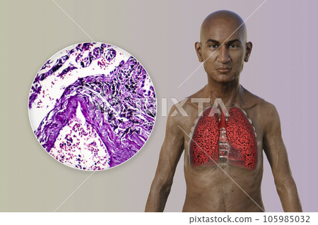 A 3D illustration of a man with transparent skin, revealing the condition of smoker's lungs A 3D illustration of a man with transparent skin, revealing the condition of smoker's lungs 105985032
