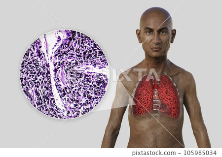 A 3D illustration of a man with transparent skin, revealing the condition of smoker's lungs A 3D illustration of a man with transparent skin, revealing the condition of smoker's lungs 105985034