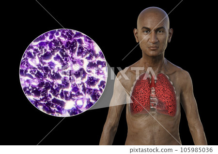 A 3D illustration of a man with transparent skin, revealing the condition of smoker's lungs 105985036
