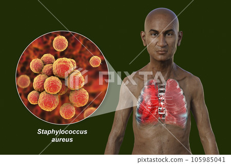 A 3D illustration showcasing the upper half part of a man with transparent skin, revealing the lungs affected by pneumonia 105985041