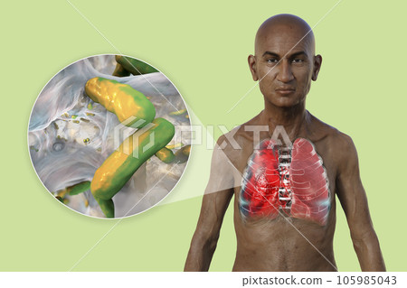 A 3D illustration showcasing the upper half part of a man with transparent skin, revealing the lungs affected by pneumonia A 3D illustration showcasing the upper half part of a man with transparent skin, revealing the lungs affected by pneumonia 105985043
