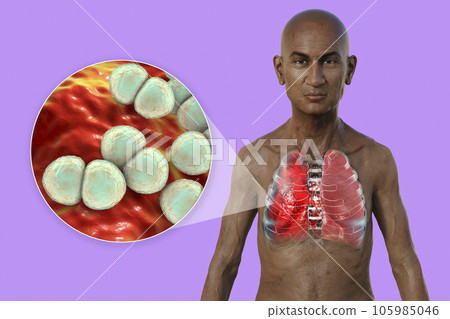 A 3D illustration showcasing the upper half part of a man with transparent skin, revealing the lungs affected by pneumonia A 3D illustration showcasing the upper half part of a man with transparent skin, revealing the lungs affected by pneumonia 105985046