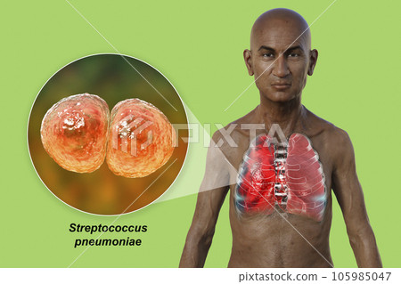 A 3D illustration showcasing the upper half part of a man with transparent skin, revealing the lungs affected by pneumonia 105985047