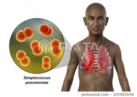 A 3D illustration showcasing the upper half part of a man with transparent skin, revealing the lungs affected by pneumonia 105985048