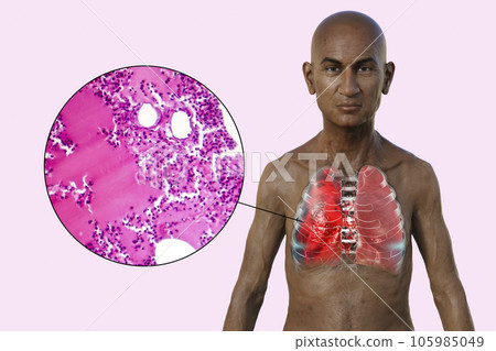 A 3D illustration showcasing the upper half part of a man with transparent skin, revealing the lungs affected by pneumonia 105985049