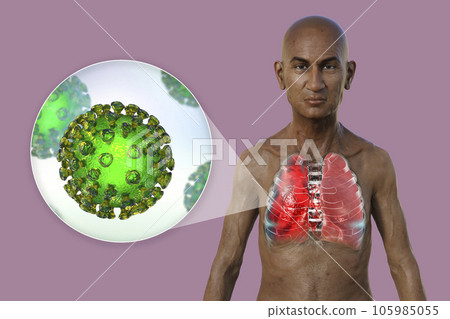A 3D illustration showcasing the upper half part of a man with transparent skin, revealing the lungs affected by Covid-19 pneumonia A 3D illustration showcasing the upper half part of a man with transparent skin, revealing the lungs affected by Covid-19 pneumonia 105985055